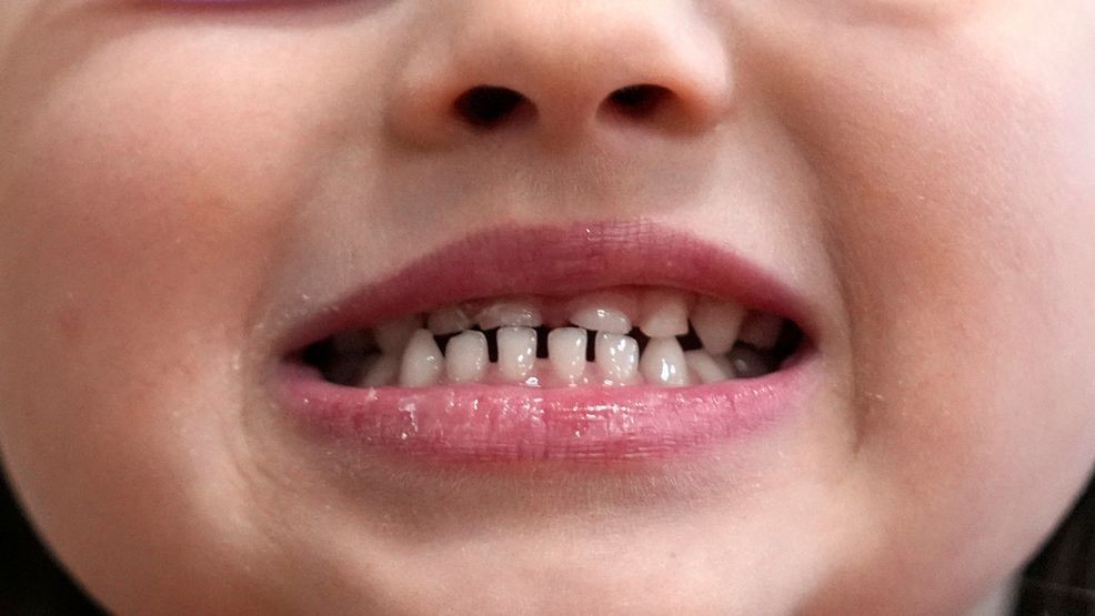 Image for story: FDA moves to ban fluoride tablets for children over health concerns